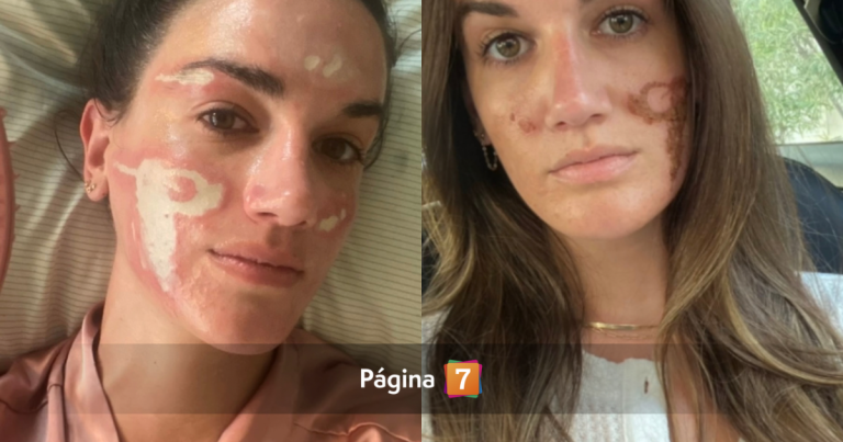 Modelo acusa a esteticista de las estrellas por dejarle cicatrices tras un tratamiento por acné