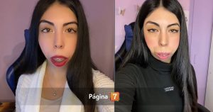 Joven con síndrome de Treacher-Collins comenzó campaña para cirugía: necesita $38 millones