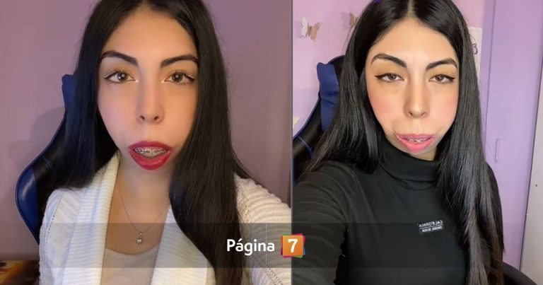 Joven con síndrome de Treacher-Collins comenzó campaña para cirugía: necesita $38 millones