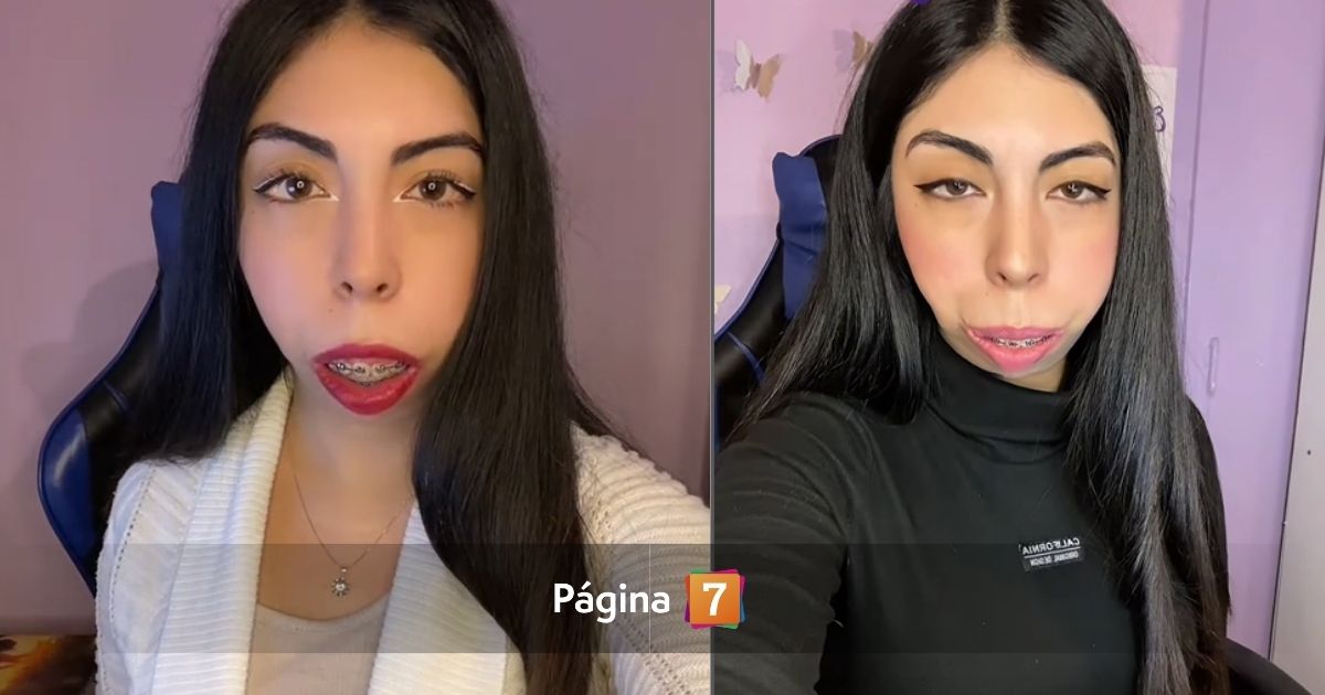 Claudia Poblete, joven con síndrome de Treacher Collins