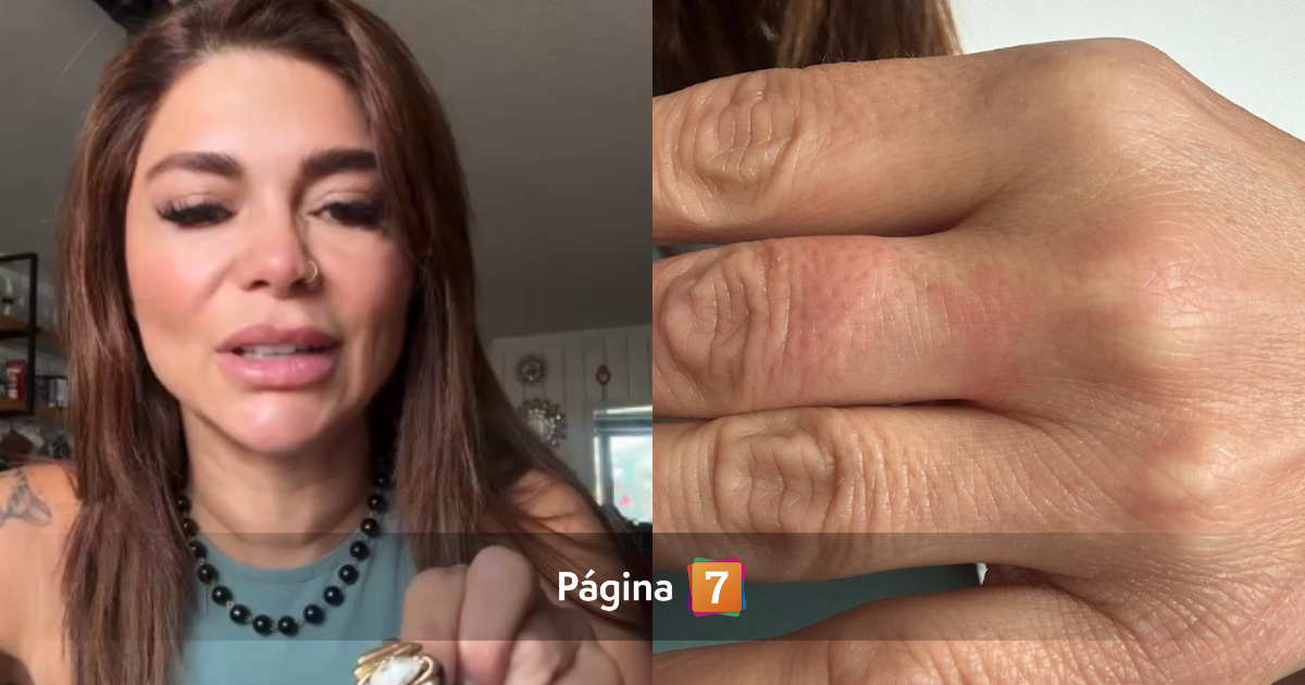 Antonella Ríos terminó en ferretería tras quedar con dedo atrapado en un anillo: "Estaba asustada"