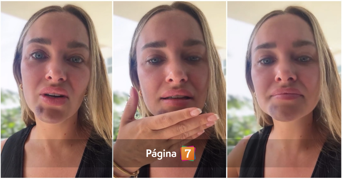 Daniela Nicolás preocupó por marcas en su cara: sufrió fuerte caída en la ducha