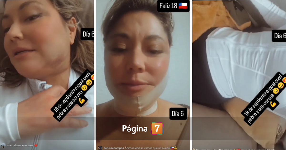 Denisse Campos registró resultados tras múltiples intervenciones estéticas: "Voy a quedar bonita"