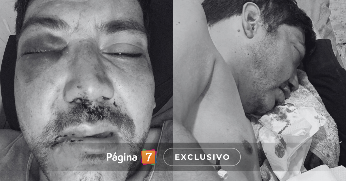 Excandidato a concejal por Santiago sufrió brutal golpiza tras intento de portonazo: “Me deformaron”