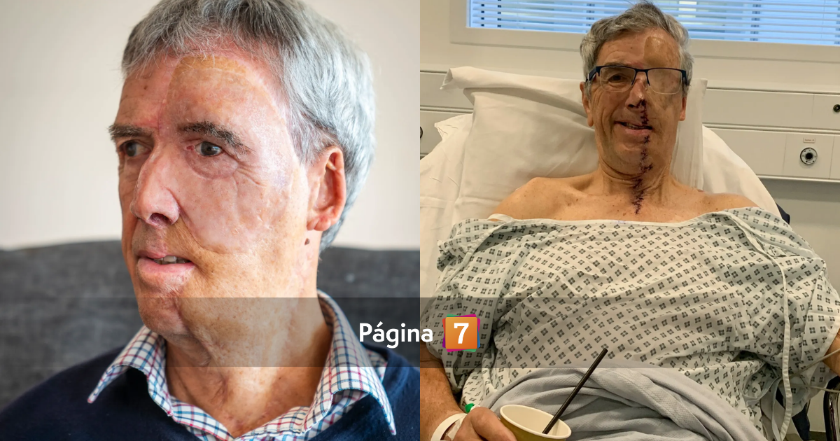 Hombre recupera rostro impresión 3D