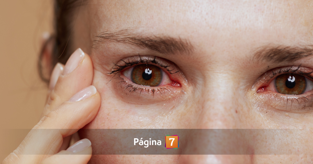 Cicatrices de lágrimas: experto explica de qué se trata la preocupación más viral de TikTok