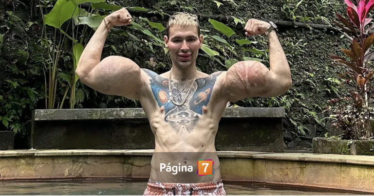 'Popeye ruso' en estado crítico: joven que se inyectaba vaselina podría quedar sin brazos