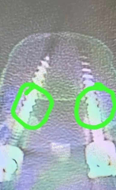 Madre denuncia mala praxis médicas tras operación a la columna