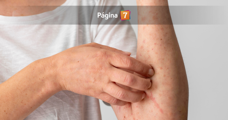 Alerta epidemiológica por brote de sarampión: cuáles son sus síntomas y quiénes pueden contagiarse