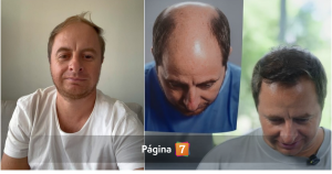 Coke Hevia y su antes y después tras implante capilar: "No fue un caso fácil"