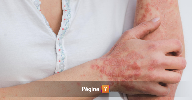 Brote de sarna Noruega en Hospital de Antofagasta: adulta mayor y 19 funcionarios contagiados