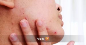 Acné hormonal en mujeres adultas: ¿por qué los brotes pueden aparecer incluso después de los 30?