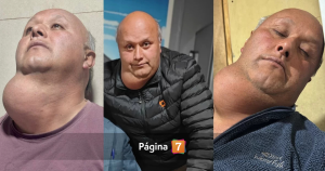 Carpintero de La Araucanía lleva 17 años esperando cirugía por bocio: su salud empeora