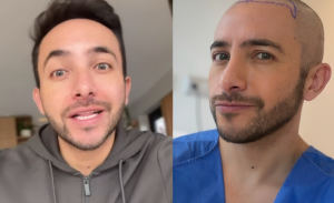 Hugo Valencia sorprendió al aparecer completamente rapado: reveló que se sometió a cirugía estética