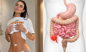 Más allá del dolor abdominal: los síntomas atípicos de la apendicitis que sufrió Emilia Dides