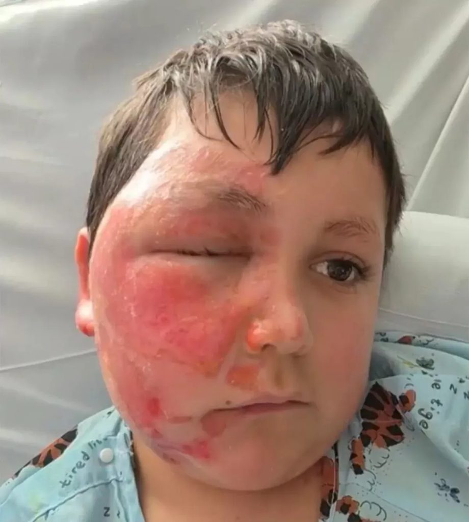 Alertan por juguetes sensoriales vendidos en Chile que pueden provocar graves quemaduras en niños