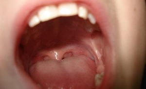 Cáncer colorrectal: las 