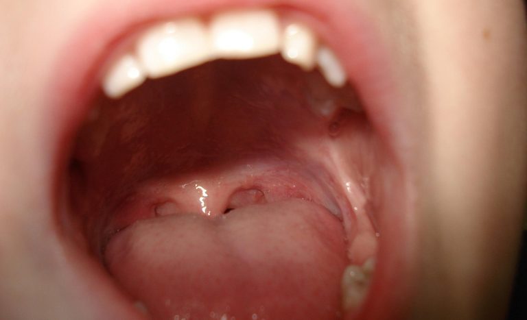 Cáncer colorrectal: las 
