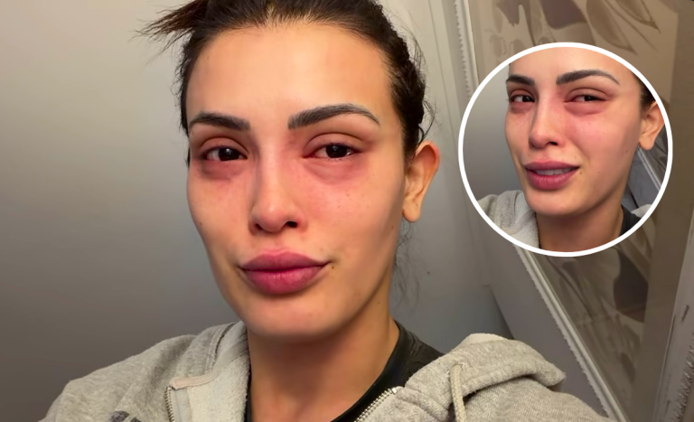 Cony Capelli sufrió fuerte reacción alérgica y mostró cómo quedó su cara: “No puedo ser tan...”