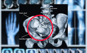 Mujer consultó por dolor abdominal y descubrieron que llevaba 3 años con un "bebé de piedra"
