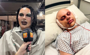 Reina de Chile revela la verdad tras intervención estética en su rostro: 